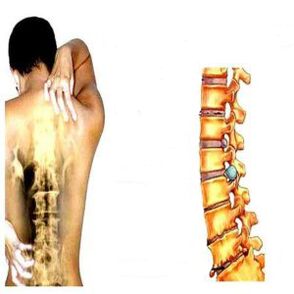 Stadien der Osteochondrose