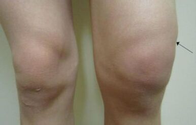 Klinische Manifestationen der Arthrose des Kniegelenks