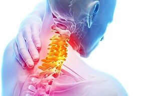 Symptome von Hals -Osteochondrose- und Ernährungsregeln für Krankheiten