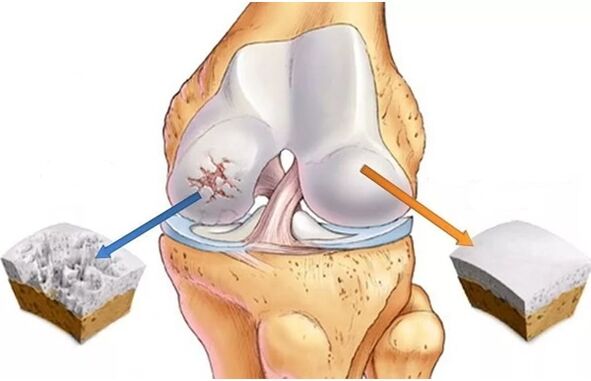 Gesunder Knorpel und Knorpel, der durch Arthrose betroffen ist