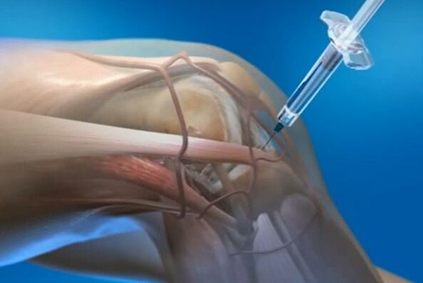 intra -kartikuläre Injektionen zur Arthrose des Kniegelenks