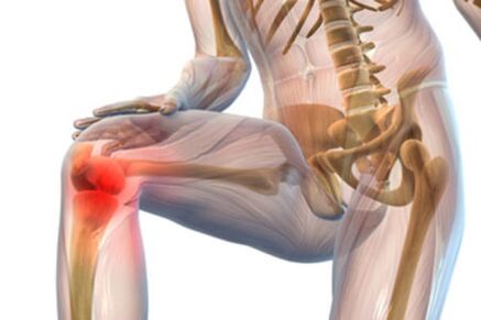 Schmerzen im Kniegelenk bei Arthrose