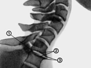 Osteophyten in der Halswirbelsäule mit Osteochondrose