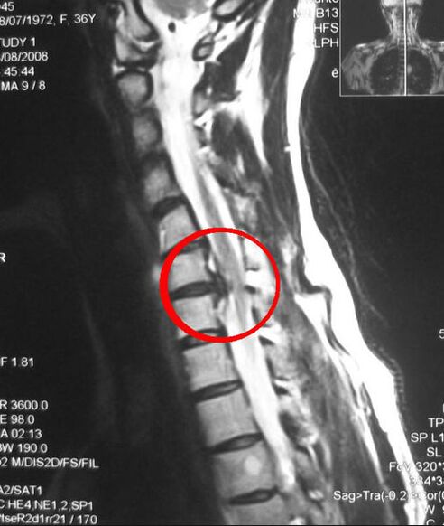 Symptome einer thorakalen Osteochondrose im Röntgenbild