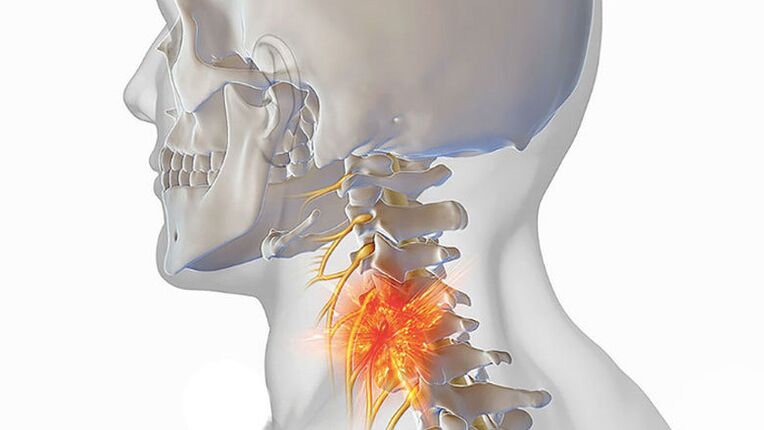 Schmerzquelle bei zervikaler Osteochondrose